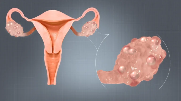 Is It Just Irregular Periods — Or Something More? What Every Woman Should Know About PCOS