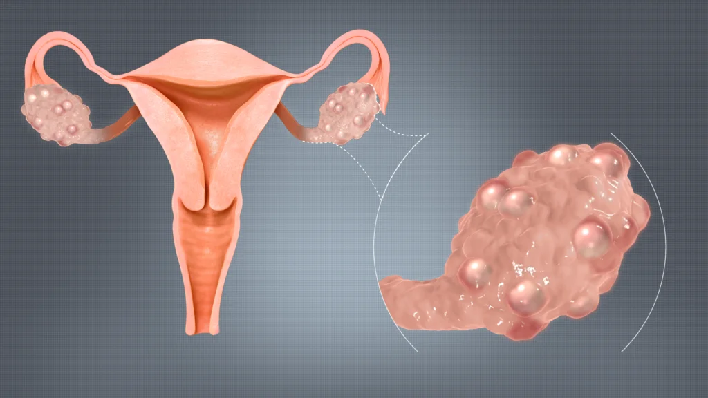 Is It Just Irregular Periods — Or Something More? What Every Woman Should Know About PCOS